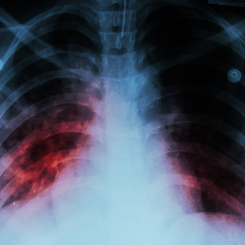 Pulmonary Tuberculosis ( TB ) : Chest x-ray show